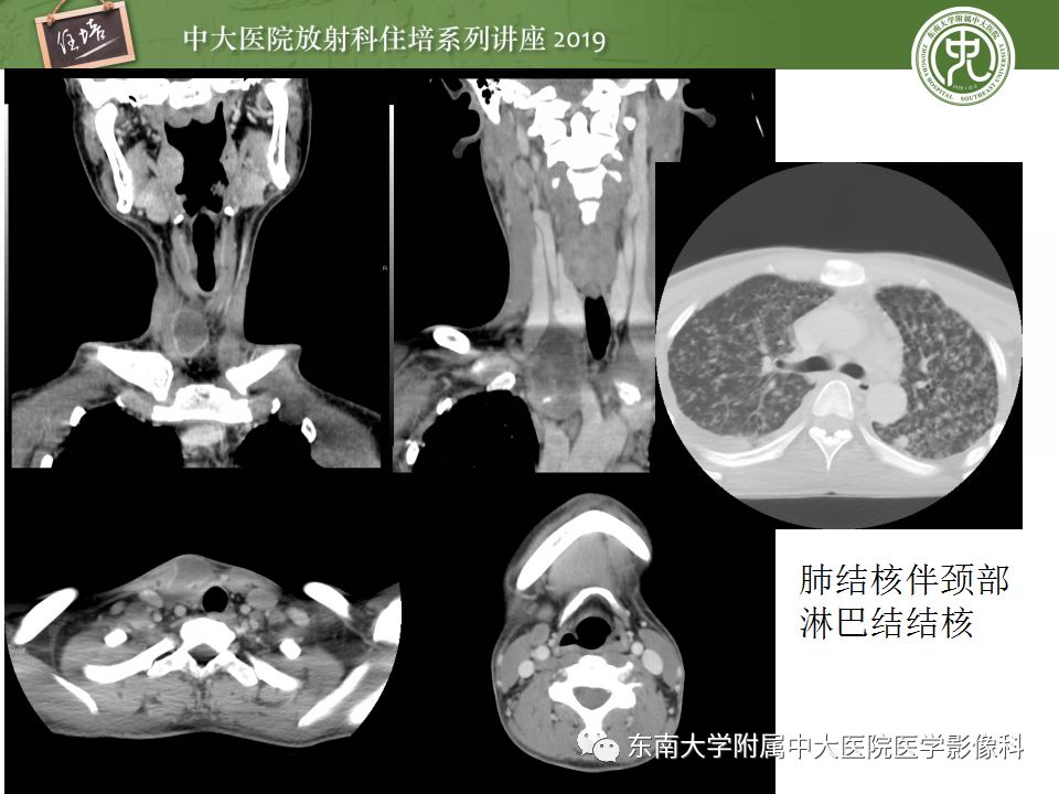 【PPT】颈部淋巴结的影像解剖及常见病变的影像表现-28