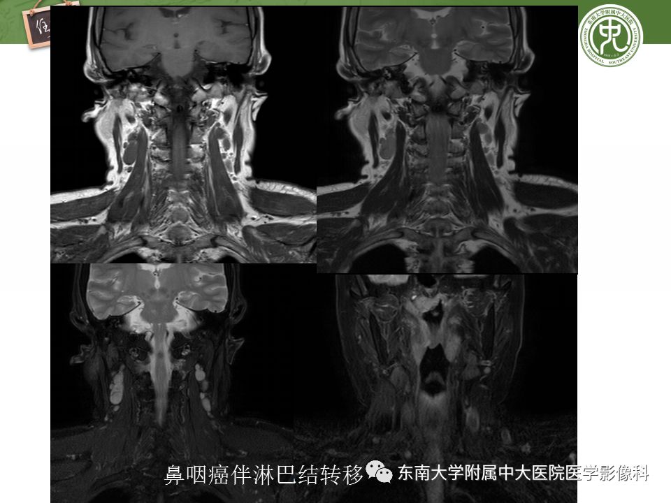 【PPT】颈部淋巴结的影像解剖及常见病变的影像表现-31