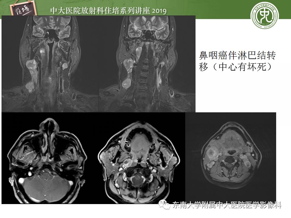 【PPT】颈部淋巴结的影像解剖及常见病变的影像表现-33