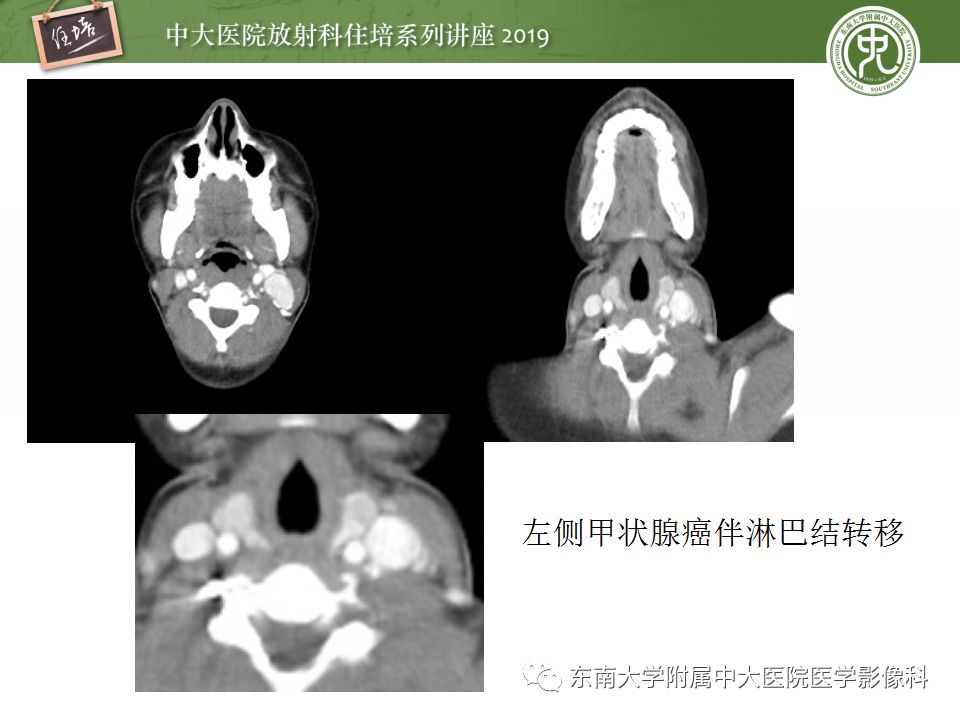 【PPT】颈部淋巴结的影像解剖及常见病变的影像表现-35