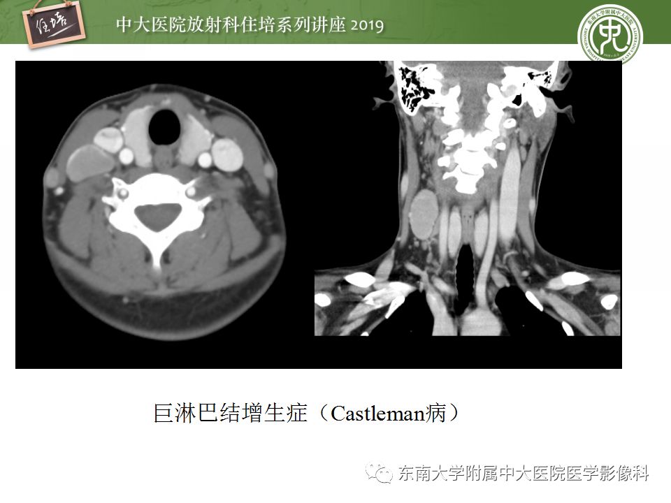 【PPT】颈部淋巴结的影像解剖及常见病变的影像表现-42