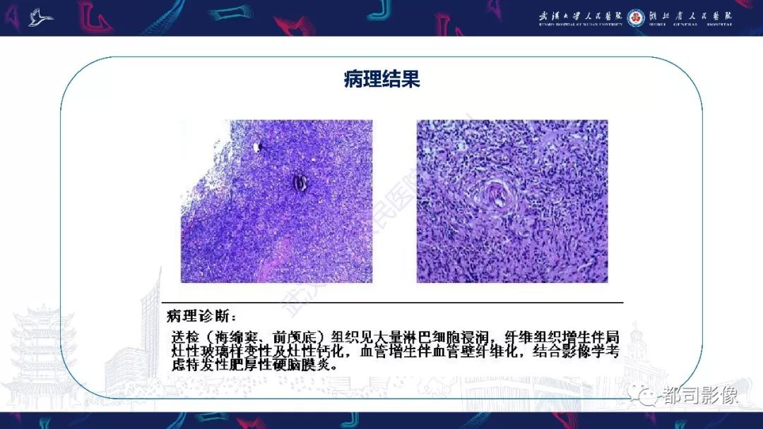 【PPT】肥厚性硬脑膜炎影像诊断-9