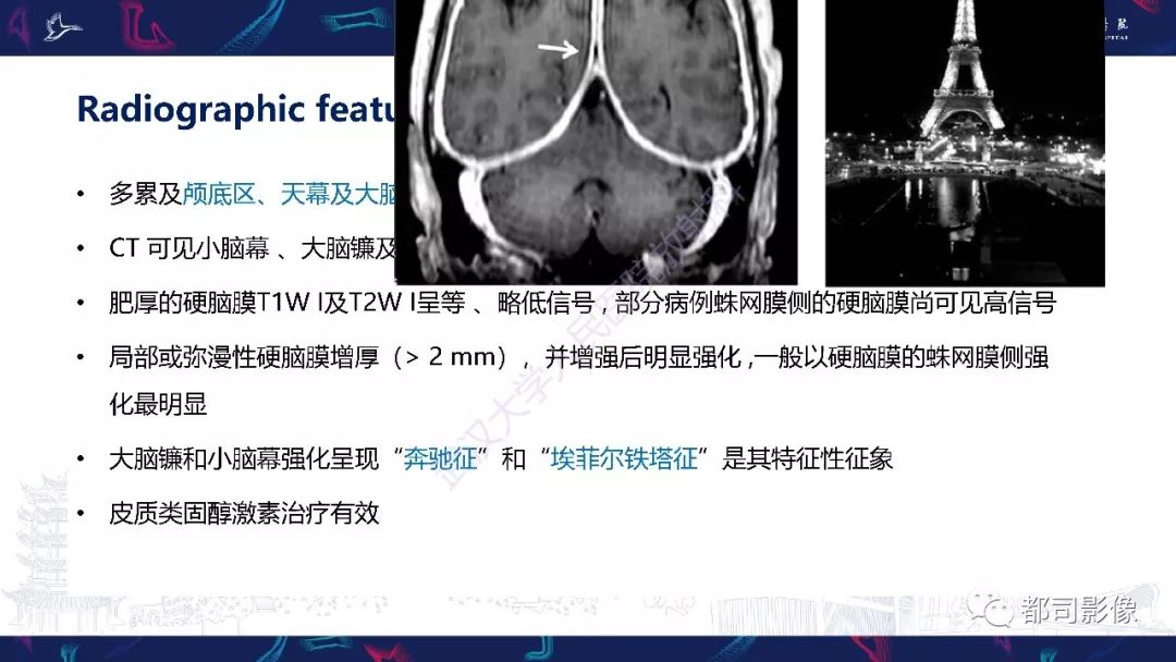 【PPT】肥厚性硬脑膜炎影像诊断-13