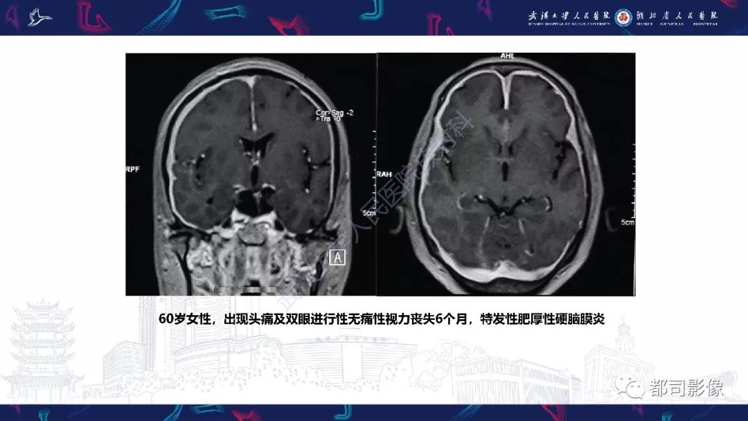 【PPT】肥厚性硬脑膜炎影像诊断-14