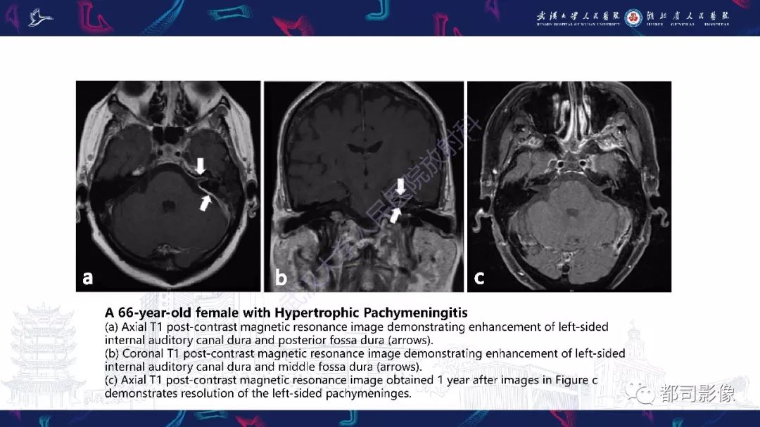 【PPT】肥厚性硬脑膜炎影像诊断-15