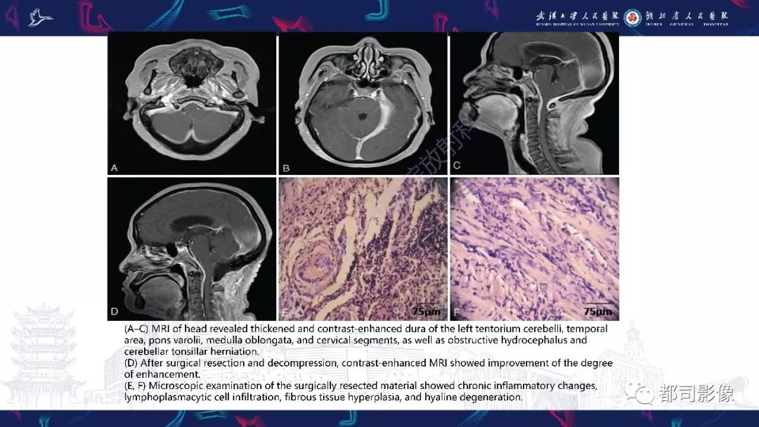 【PPT】肥厚性硬脑膜炎影像诊断-16