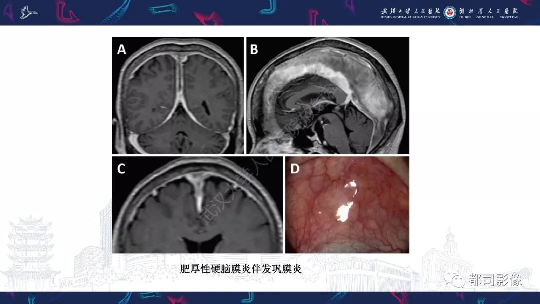 【PPT】肥厚性硬脑膜炎影像诊断-17