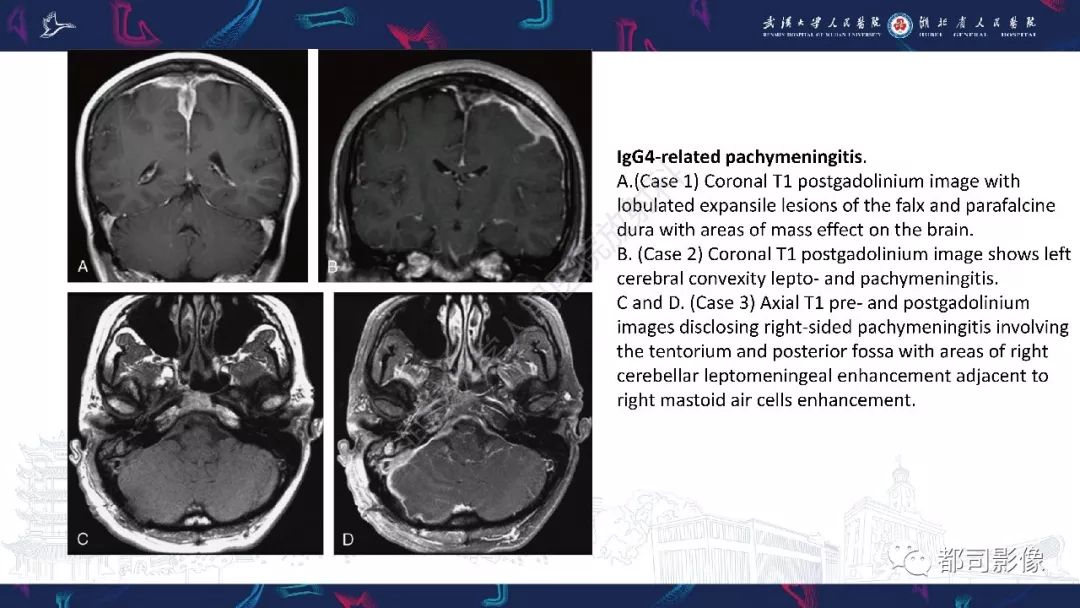 【PPT】肥厚性硬脑膜炎影像诊断-18