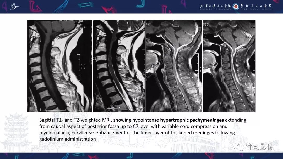 【PPT】肥厚性硬脑膜炎影像诊断-19