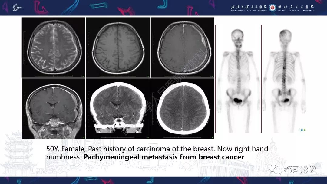 【PPT】肥厚性硬脑膜炎影像诊断-21