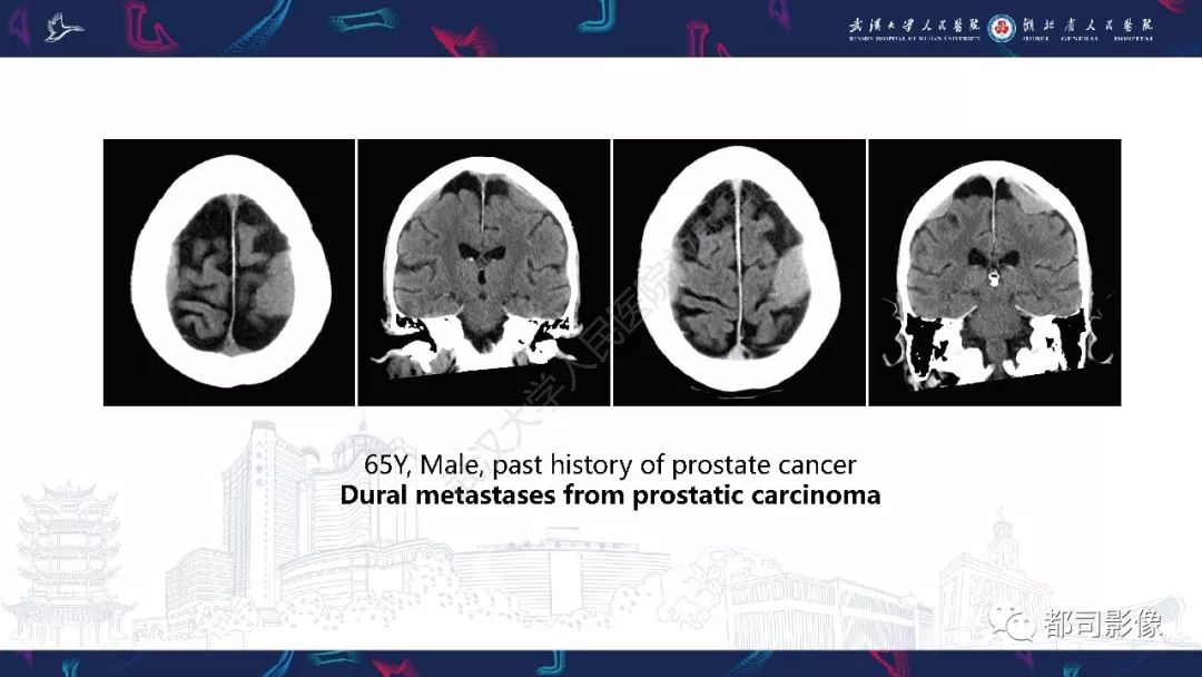 【PPT】肥厚性硬脑膜炎影像诊断-22