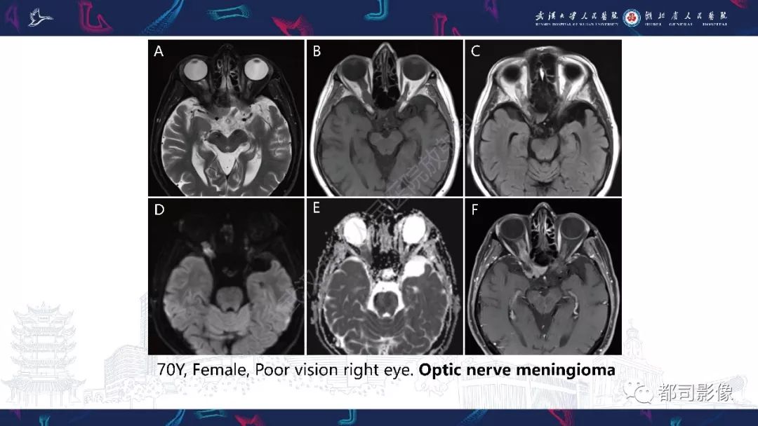 【PPT】肥厚性硬脑膜炎影像诊断-23
