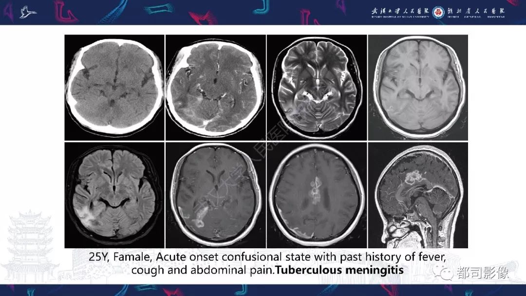 【PPT】肥厚性硬脑膜炎影像诊断-26