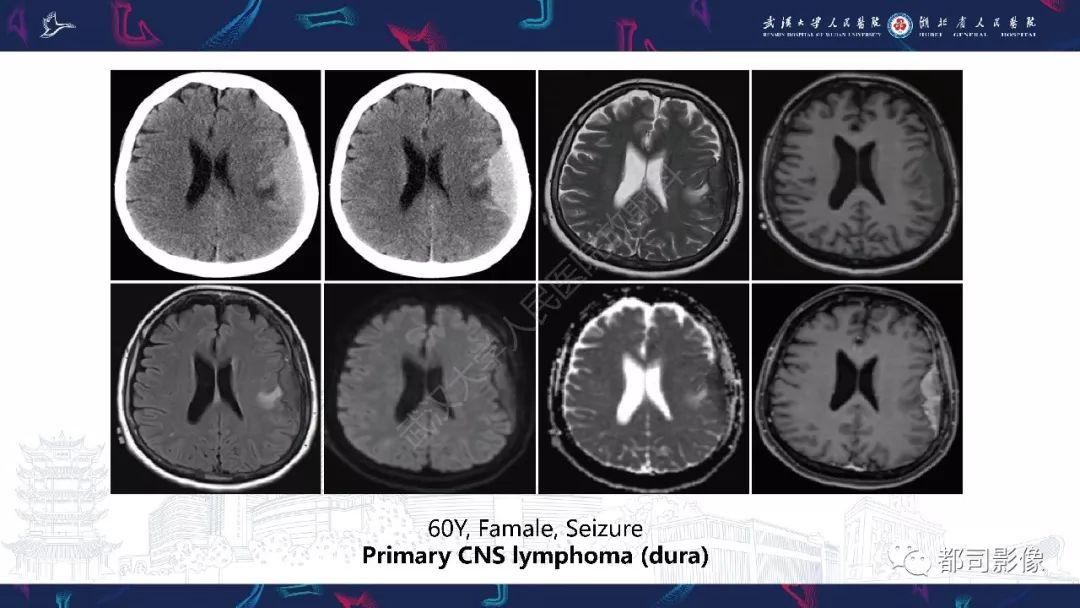 【PPT】肥厚性硬脑膜炎影像诊断-25
