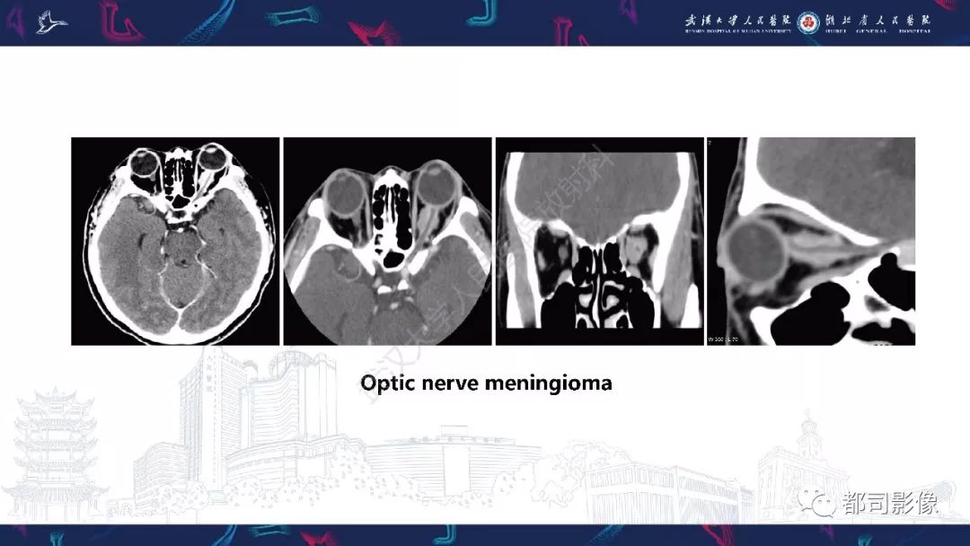 【PPT】肥厚性硬脑膜炎影像诊断-24