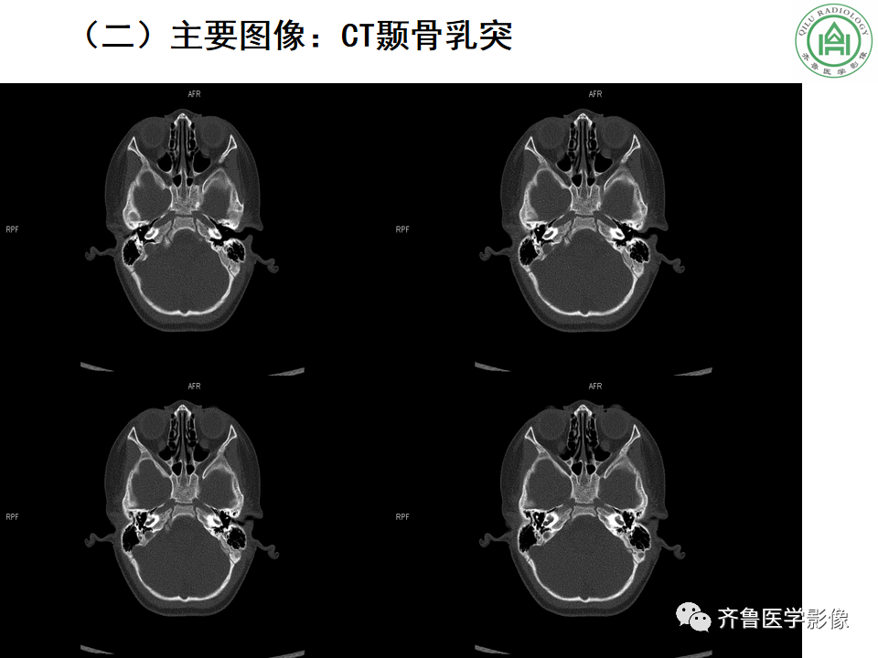 【PPT】内耳畸形—耳部病变早读片病例-3