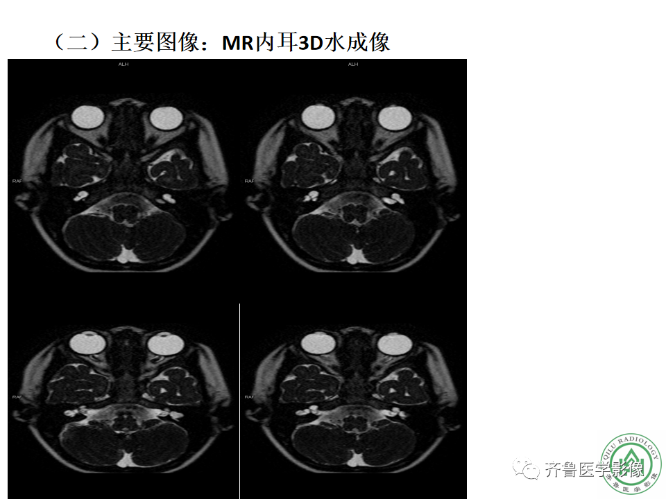 【PPT】内耳畸形—耳部病变早读片病例-5