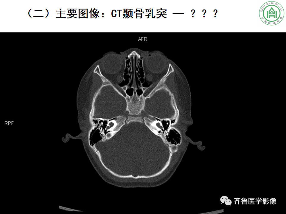 【PPT】内耳畸形—耳部病变早读片病例-4