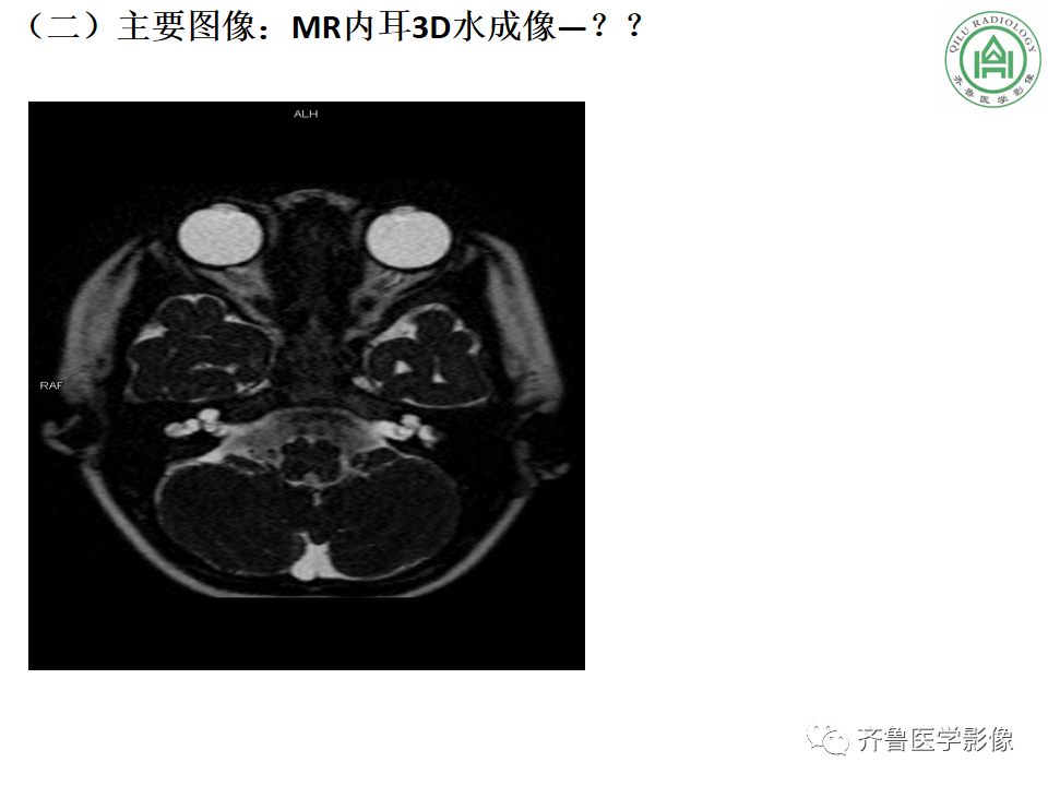 【PPT】内耳畸形—耳部病变早读片病例-6