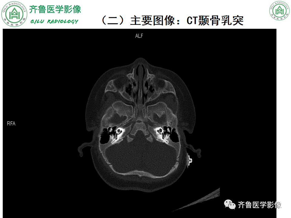 【PPT】内耳畸形—耳部病变早读片病例-9