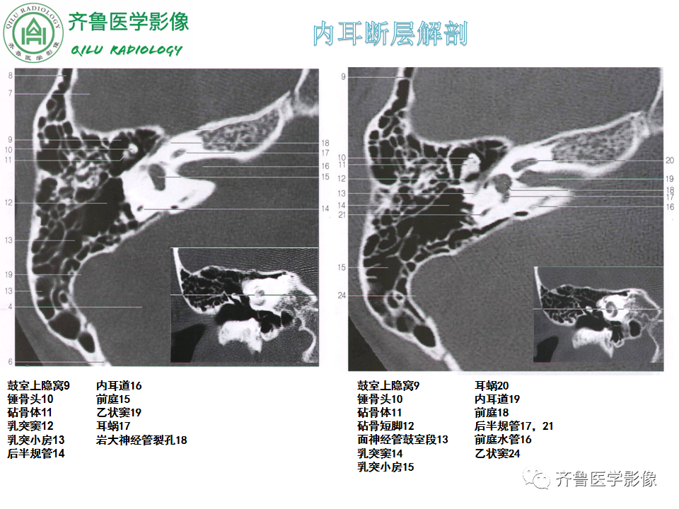 【PPT】内耳畸形—耳部病变早读片病例-15