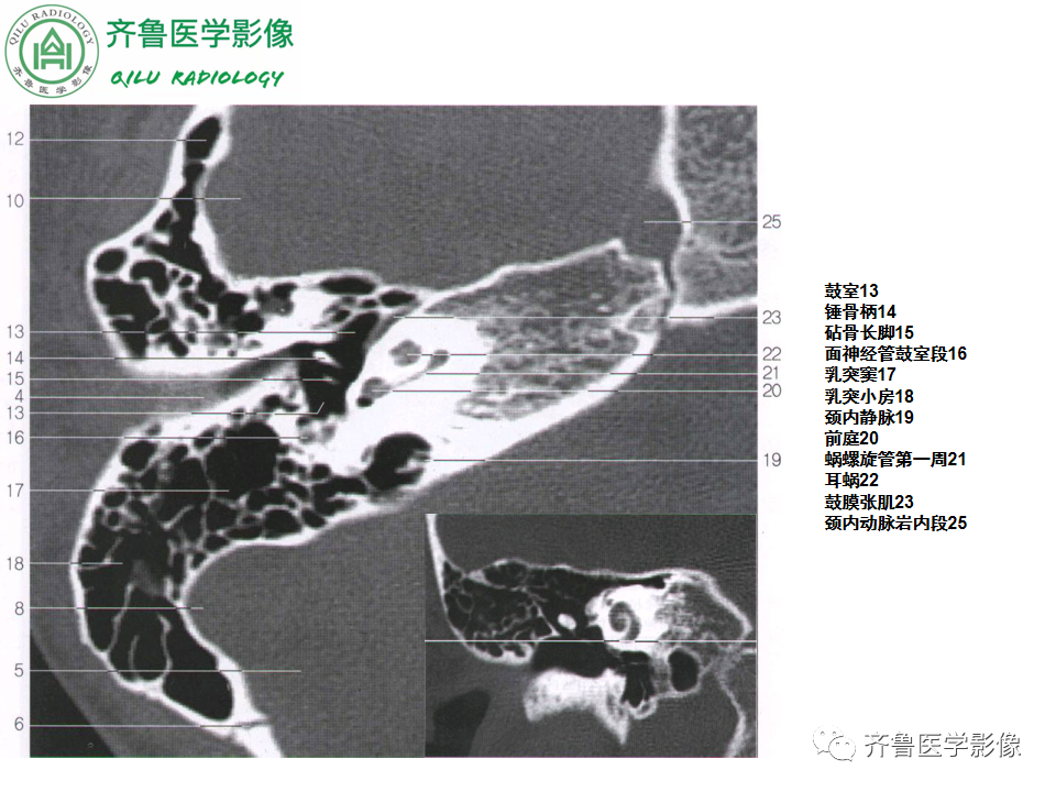 【PPT】内耳畸形—耳部病变早读片病例-16