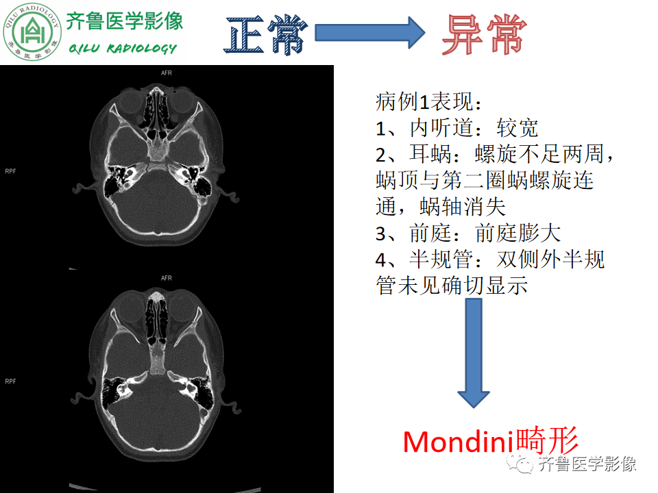 【PPT】内耳畸形—耳部病变早读片病例-18