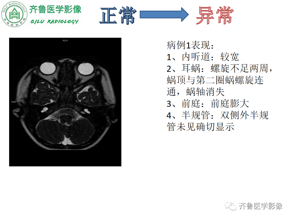 【PPT】内耳畸形—耳部病变早读片病例-17