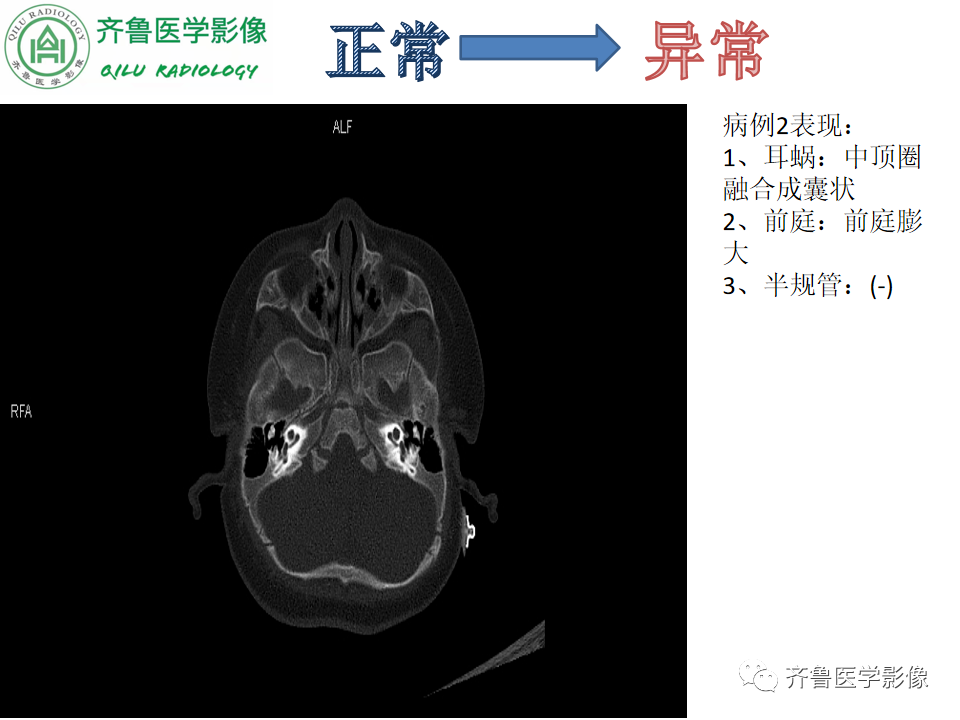 【PPT】内耳畸形—耳部病变早读片病例-19