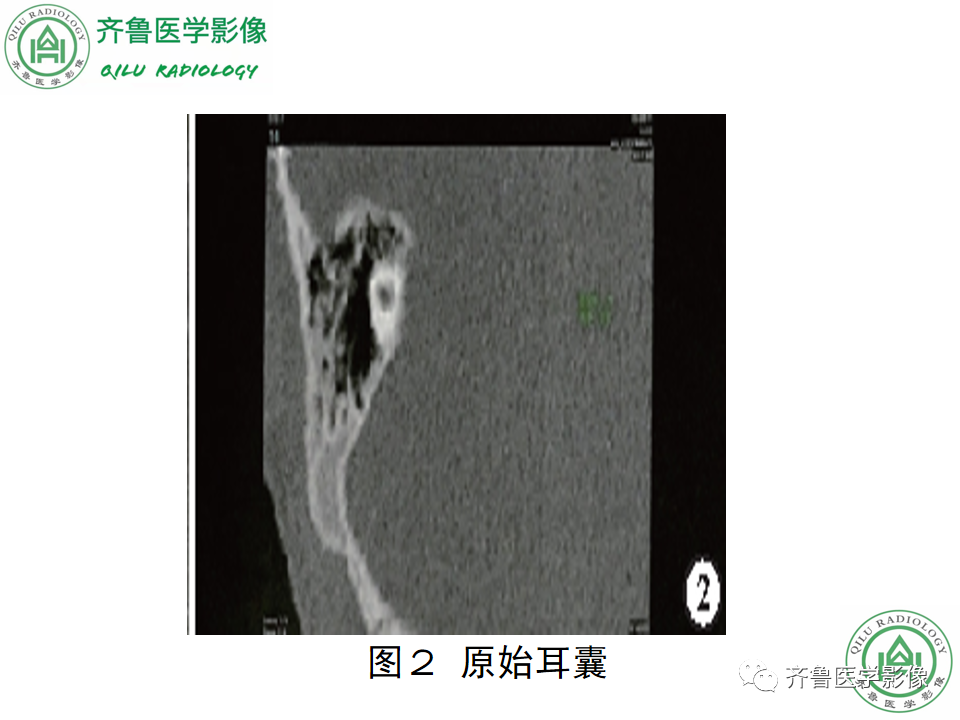 【PPT】内耳畸形—耳部病变早读片病例-23