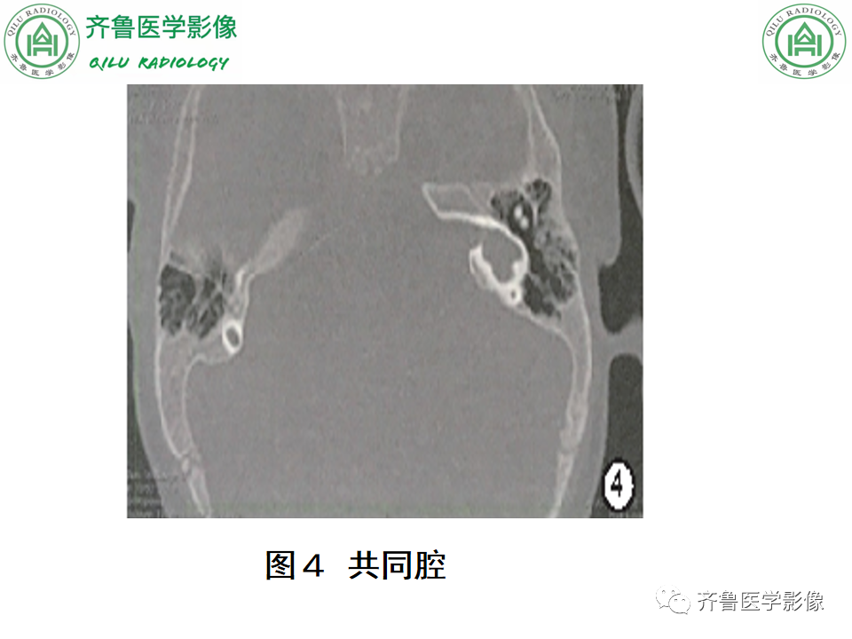 【PPT】内耳畸形—耳部病变早读片病例-25