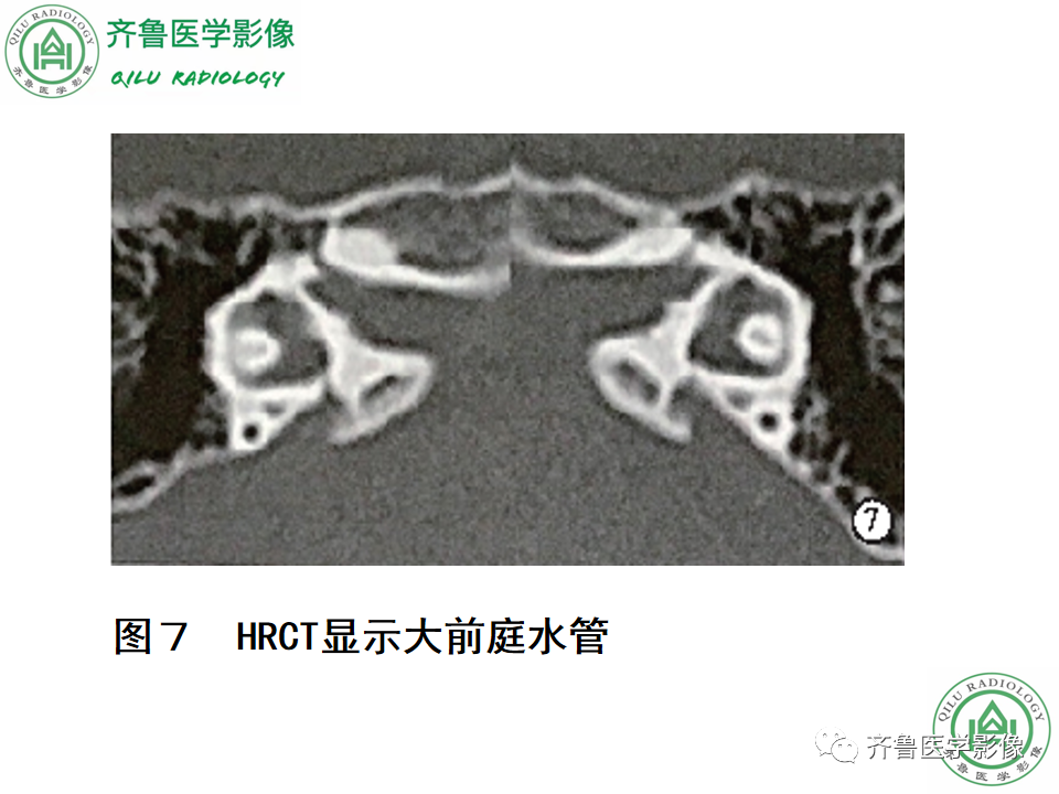 【PPT】内耳畸形—耳部病变早读片病例-30