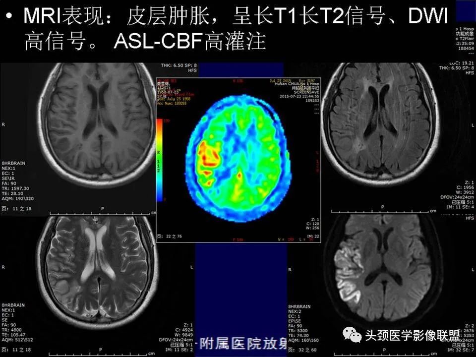【PPT】脑皮层病变的MRI表现-4