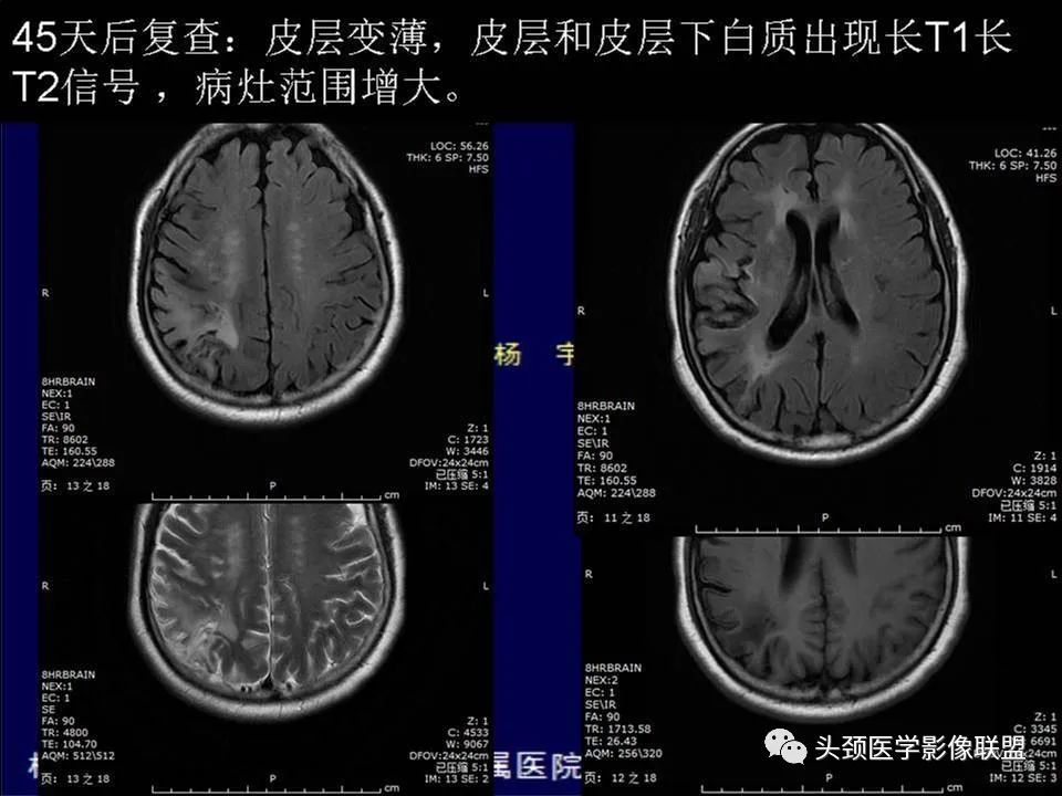 【PPT】脑皮层病变的MRI表现-6