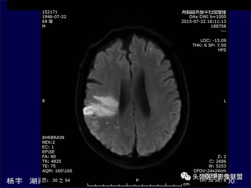 【PPT】脑皮层病变的MRI表现-9