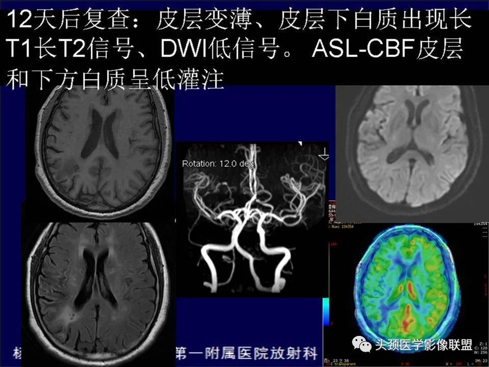 【PPT】脑皮层病变的MRI表现-5