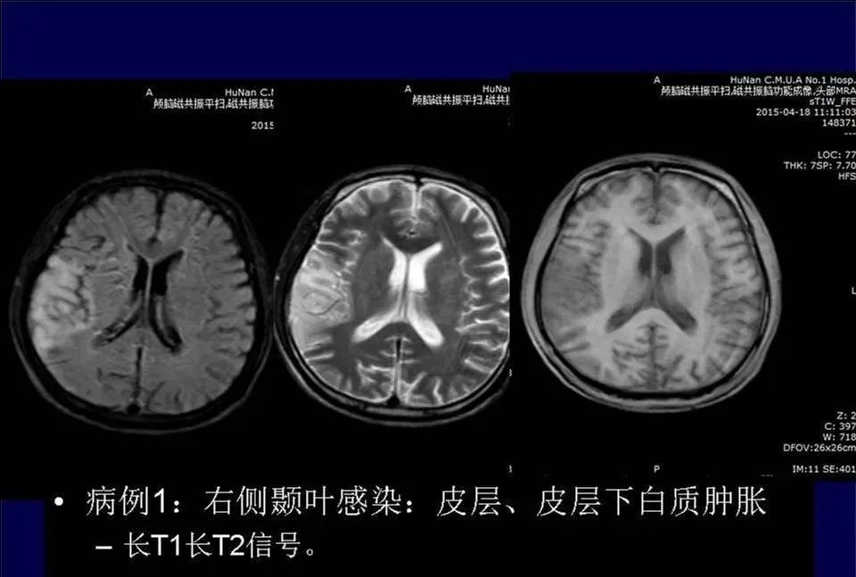【PPT】脑皮层病变的MRI表现-11