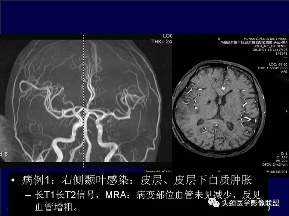 【PPT】脑皮层病变的MRI表现-12