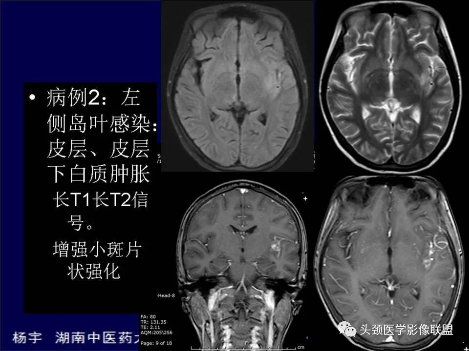 【PPT】脑皮层病变的MRI表现-13