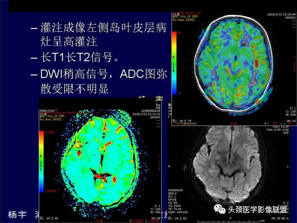 【PPT】脑皮层病变的MRI表现-14