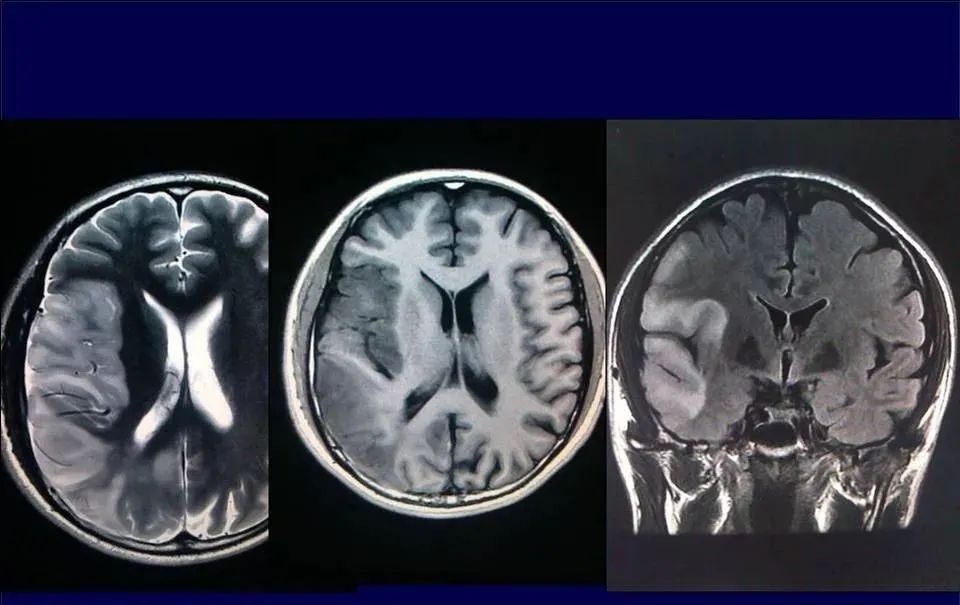 【PPT】脑皮层病变的MRI表现-17