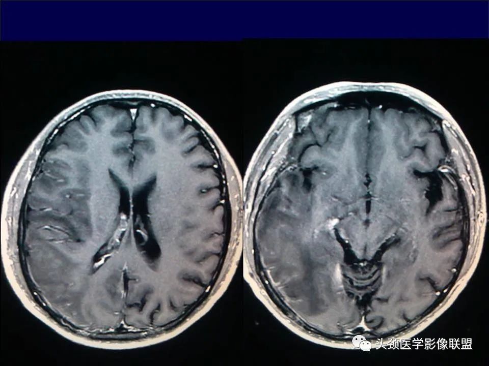 【PPT】脑皮层病变的MRI表现-19