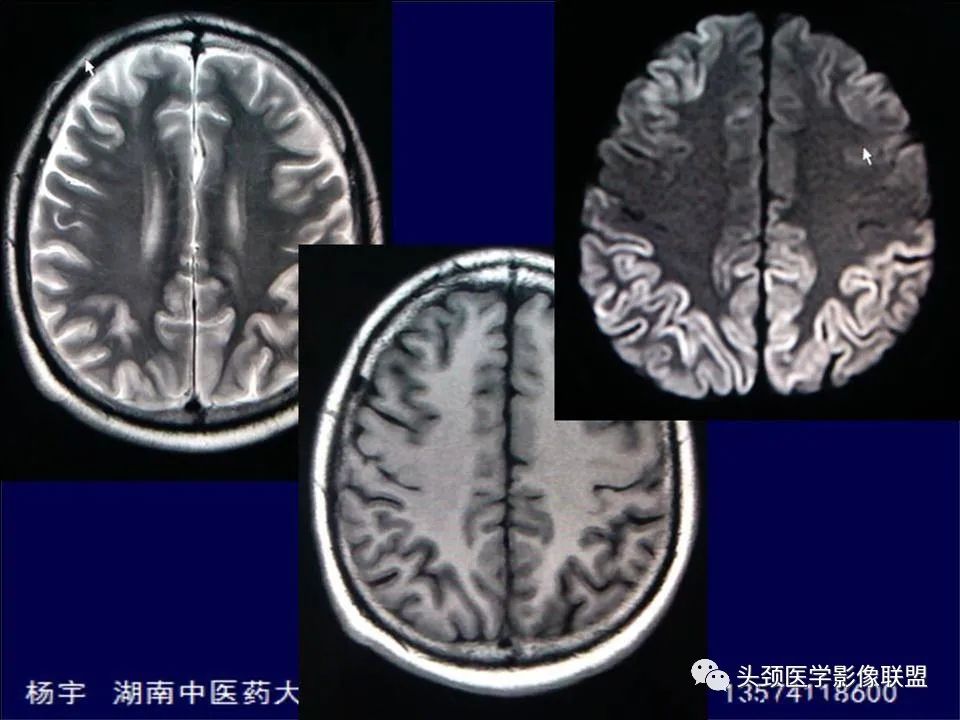 【PPT】脑皮层病变的MRI表现-24