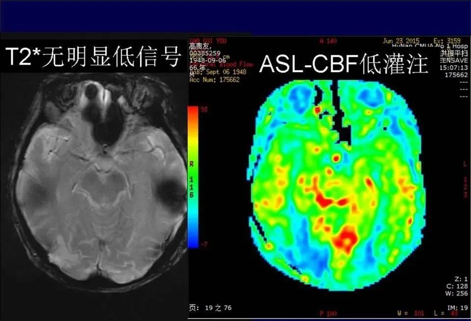 【PPT】脑皮层病变的MRI表现-29