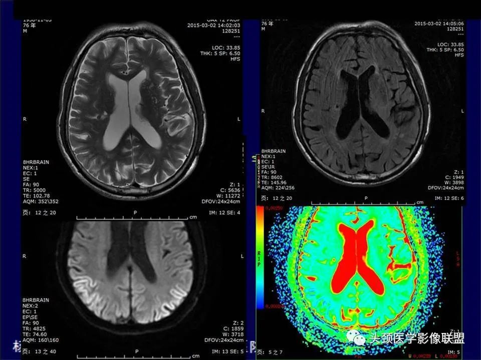 【PPT】脑皮层病变的MRI表现-25
