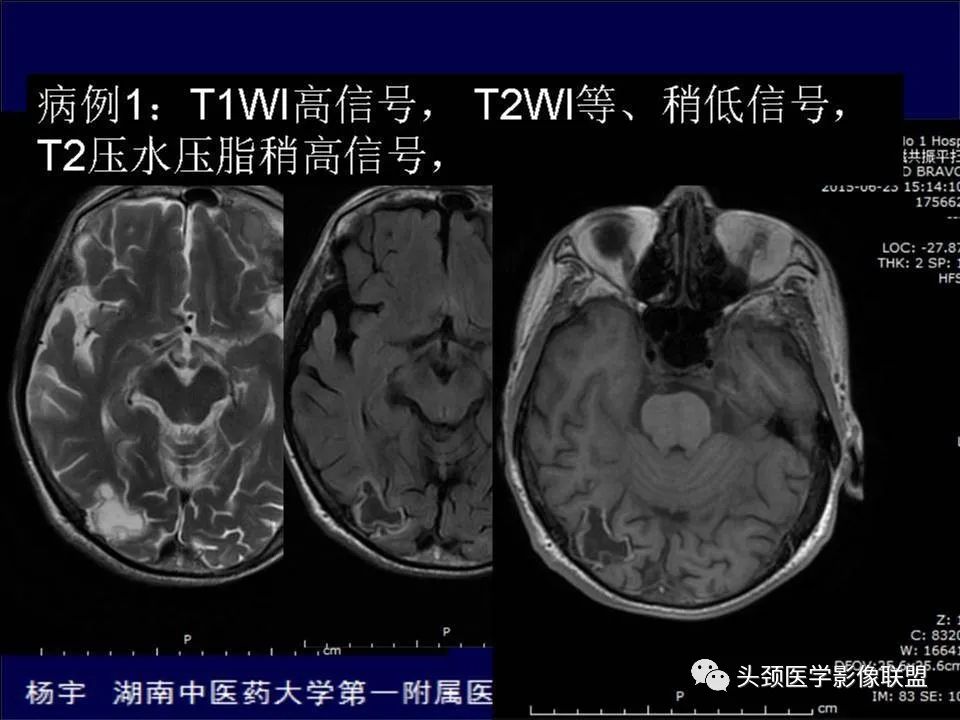 【PPT】脑皮层病变的MRI表现-27