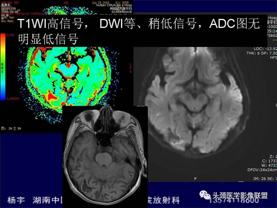 【PPT】脑皮层病变的MRI表现-28