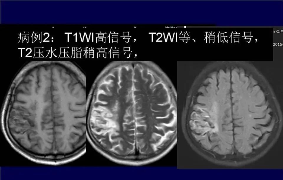 【PPT】脑皮层病变的MRI表现-30