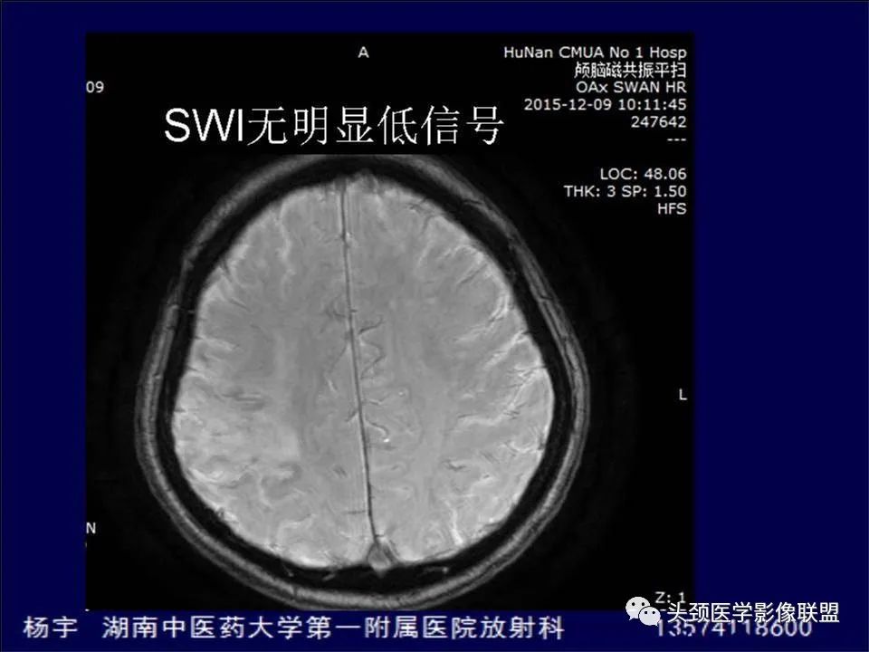 【PPT】脑皮层病变的MRI表现-31