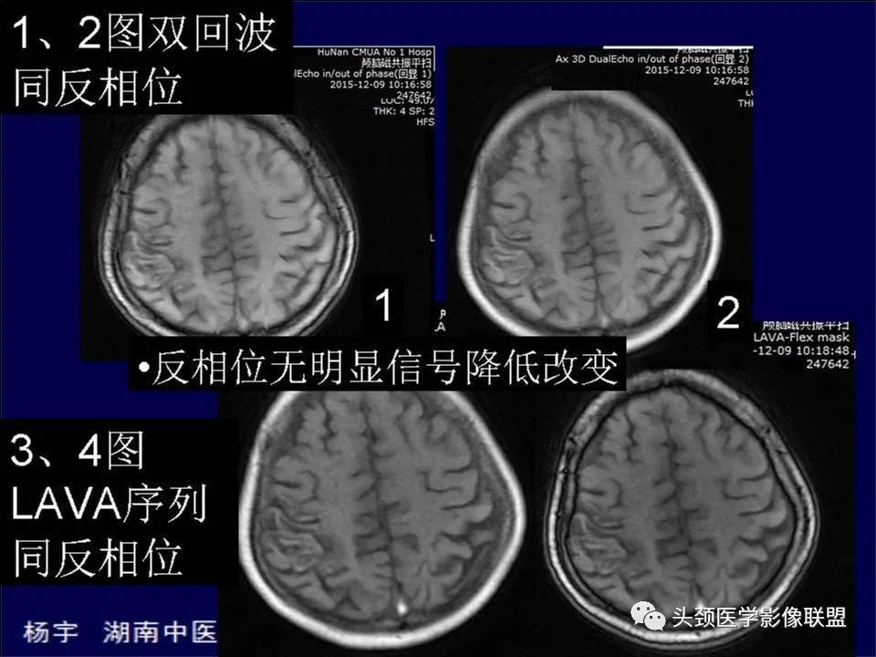 【PPT】脑皮层病变的MRI表现-32